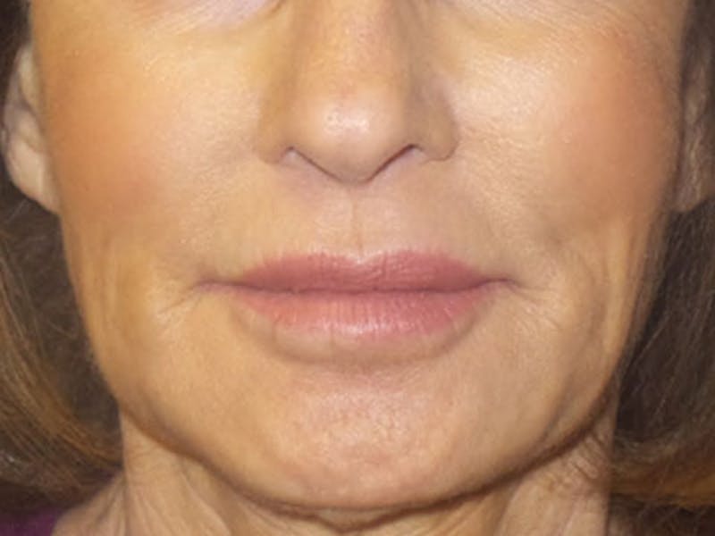 Bellafill Before & After Gallery - Patient 398734 - Image 2