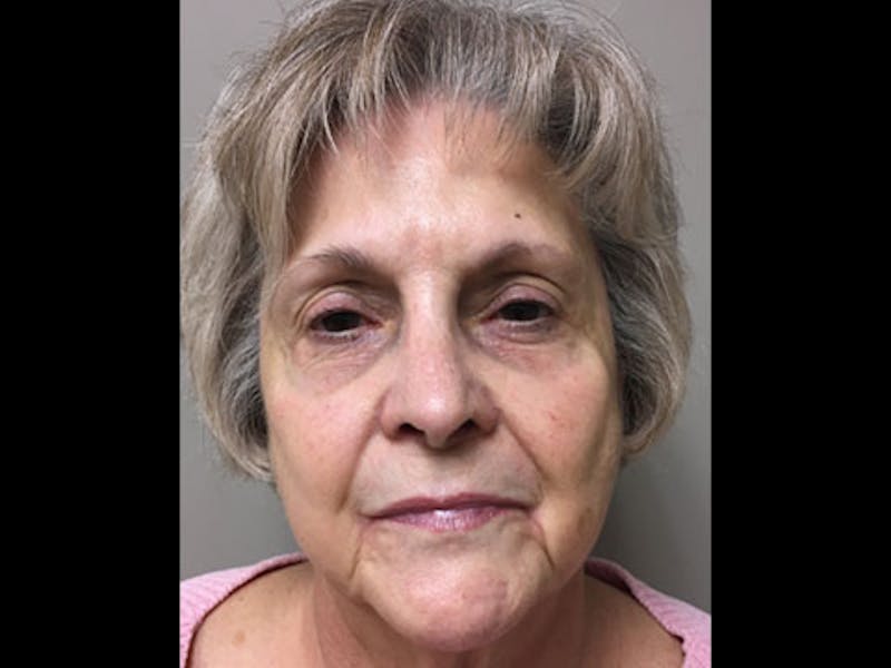 Bellafill Before & After Gallery - Patient 306720 - Image 1