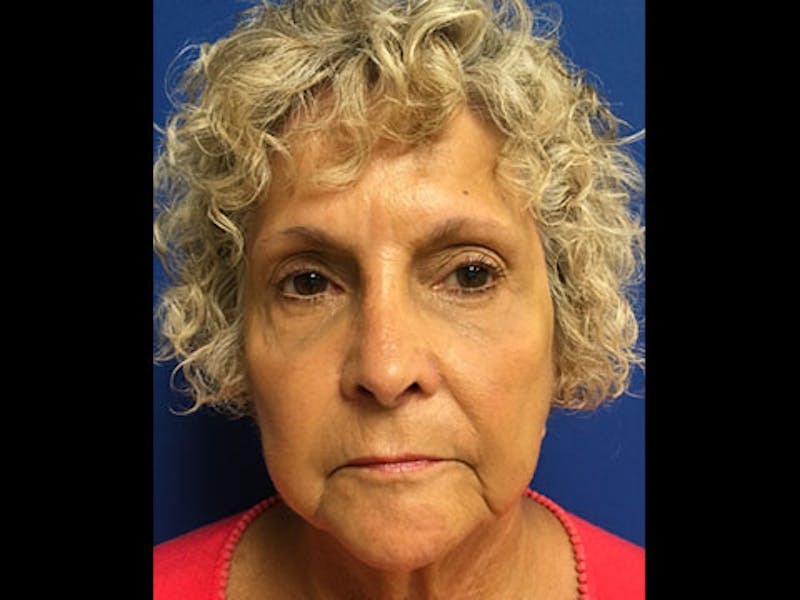 Bellafill Before & After Gallery - Patient 306720 - Image 2