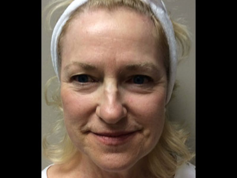Bellafill Before & After Gallery - Patient 166282 - Image 1
