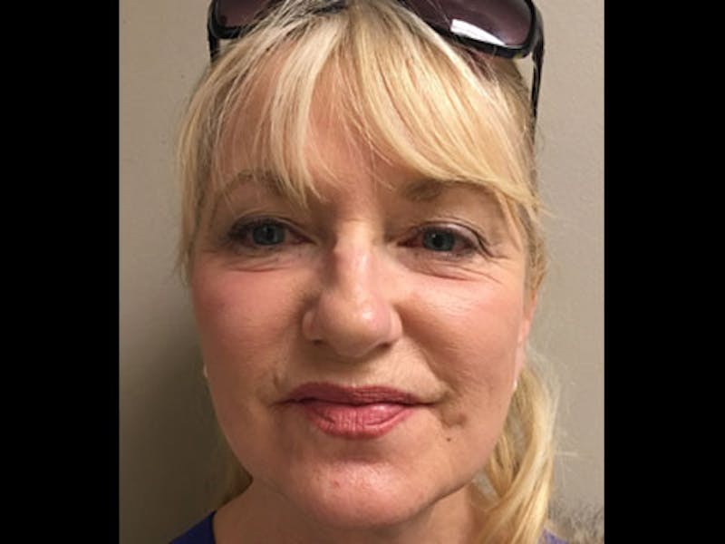Bellafill Before & After Gallery - Patient 166282 - Image 2