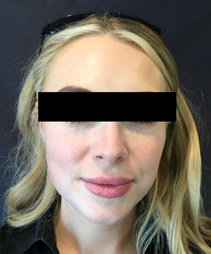 Belotero Before & After Gallery - Patient 159269 - Image 1