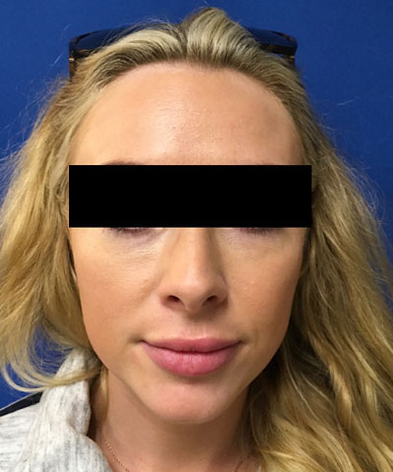 Belotero Before & After Gallery - Patient 159269 - Image 2