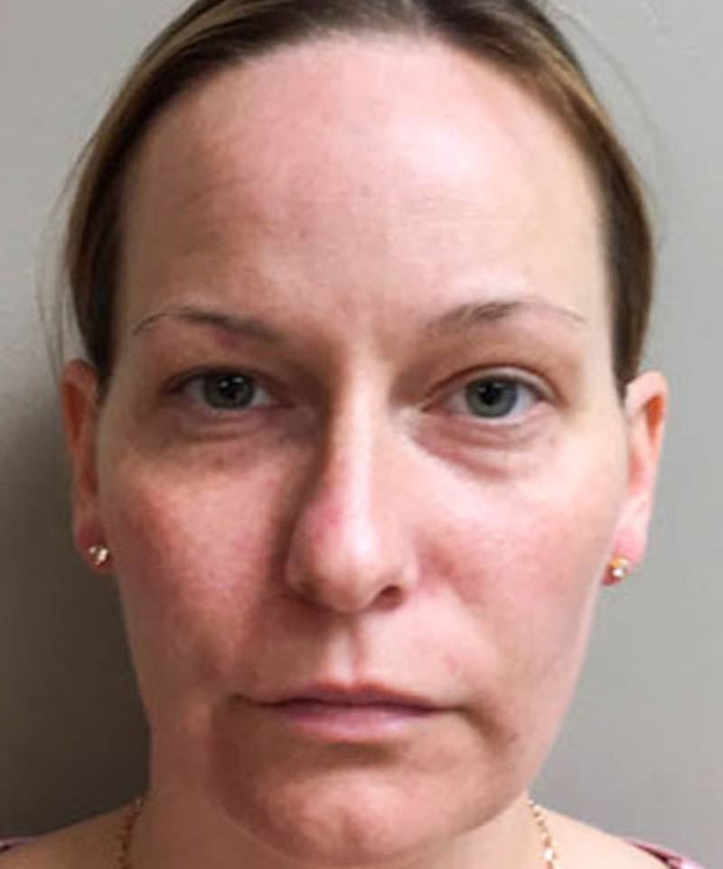Belotero Before & After Gallery - Patient 304945 - Image 1