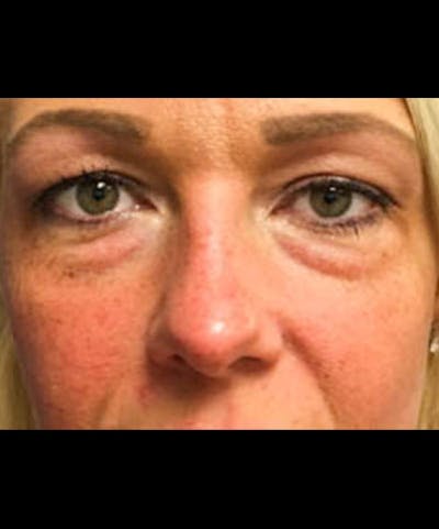 Belotero Before & After Gallery - Patient 157846 - Image 1