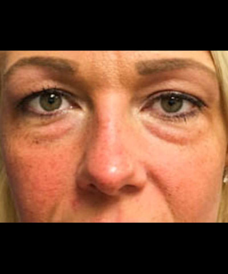 Belotero Before & After Gallery - Patient 157846 - Image 1
