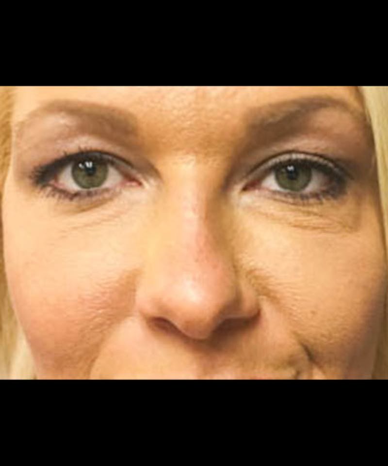 Belotero Before & After Gallery - Patient 157846 - Image 2