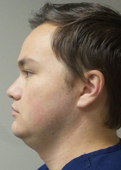 Kybella Before & After Gallery - Patient 534735 - Image 1