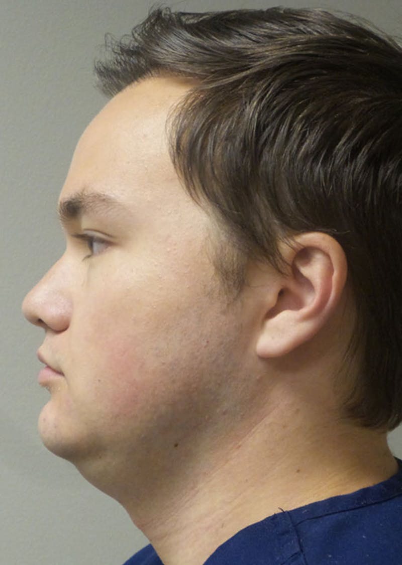 Kybella Before & After Gallery - Patient 534735 - Image 1