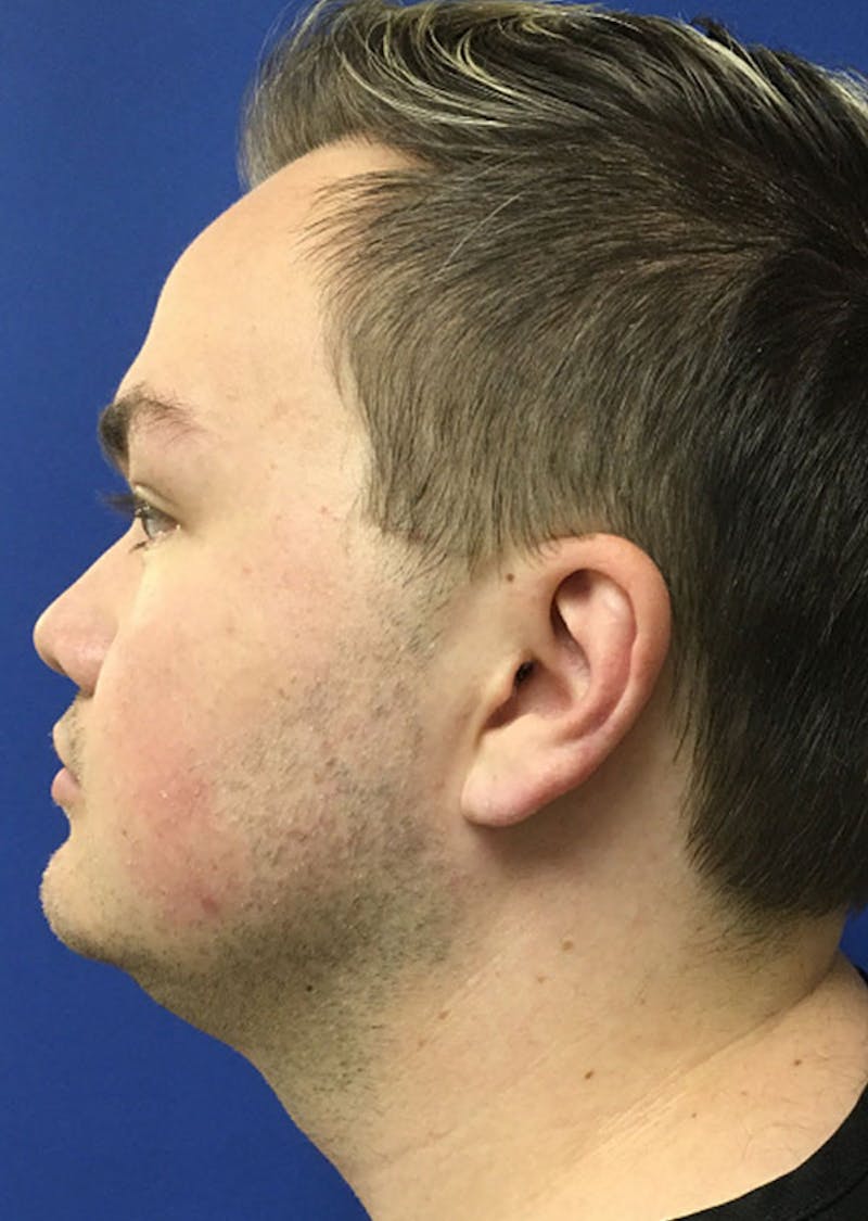 Kybella Before & After Gallery - Patient 534735 - Image 2