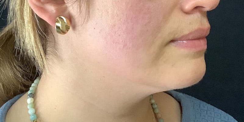 J-Plasma Before & After Gallery - Patient 335965 - Image 1