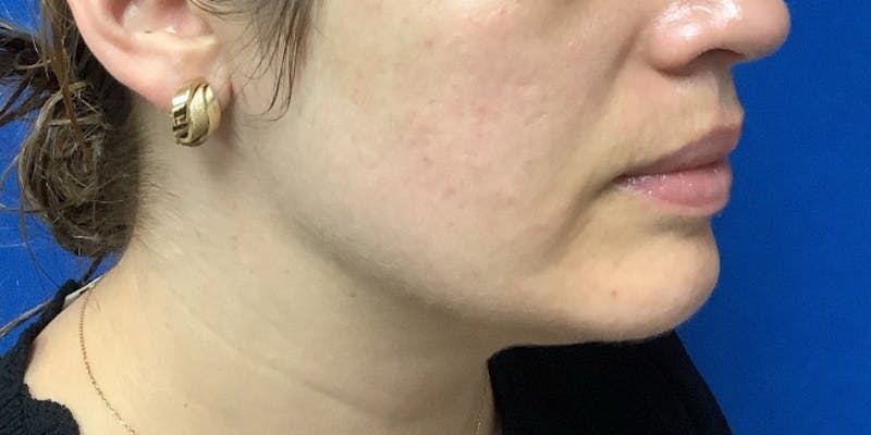 J-Plasma Before & After Gallery - Patient 335965 - Image 2