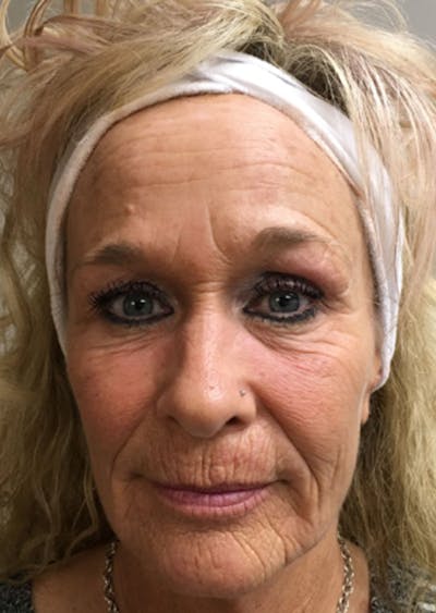 J-Plasma Before & After Gallery - Patient 626708 - Image 1