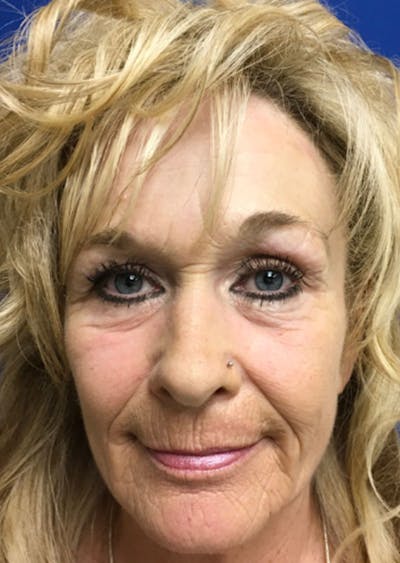 J-Plasma Before & After Gallery - Patient 626708 - Image 2