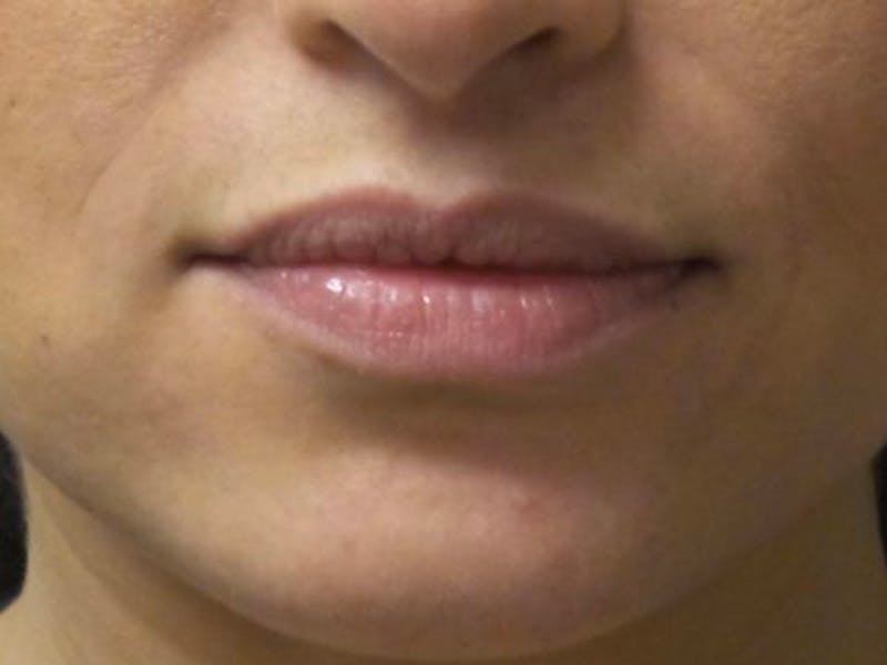 Lip Augmentation Before & After Gallery - Patient 912573 - Image 1