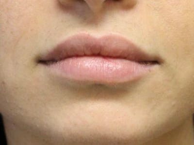 Lip Augmentation Before & After Gallery - Patient 912573 - Image 2