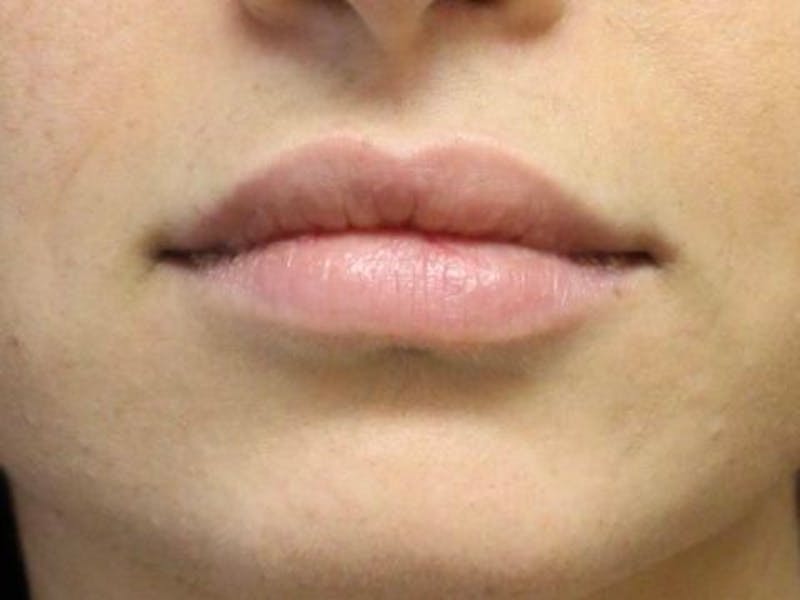 Lip Augmentation Before & After Gallery - Patient 912573 - Image 2