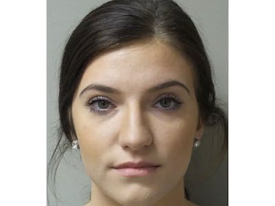 Lip Augmentation Before & After Gallery - Patient 104269 - Image 1