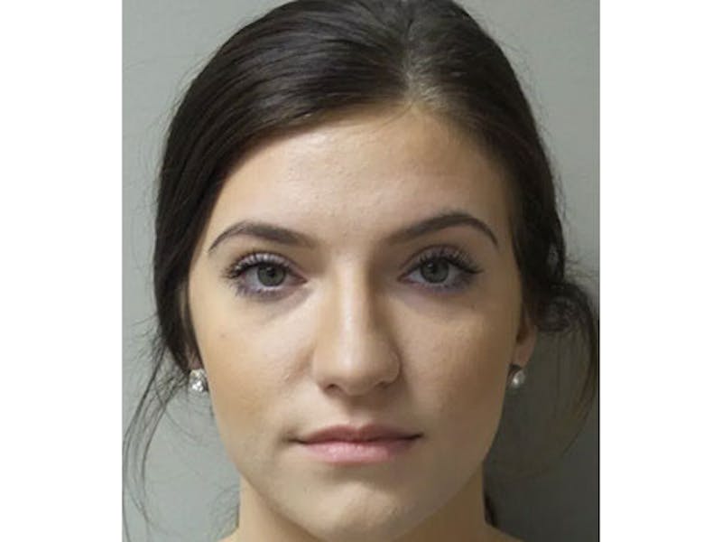 Lip Augmentation Before & After Gallery - Patient 104269 - Image 1