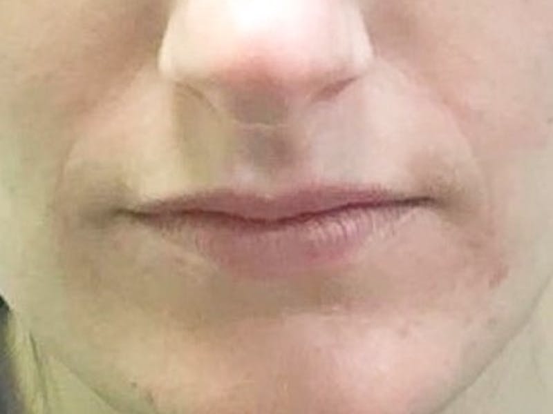 Lip Augmentation Before & After Gallery - Patient 848756 - Image 1