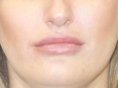 Lip Augmentation Before & After Gallery - Patient 848756 - Image 2