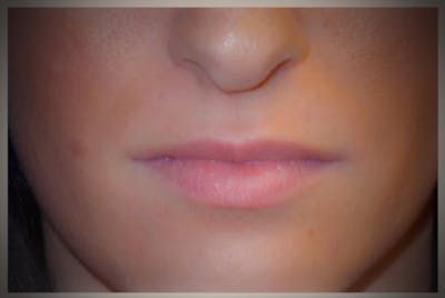 Lip Augmentation Before & After Gallery - Patient 270566 - Image 1