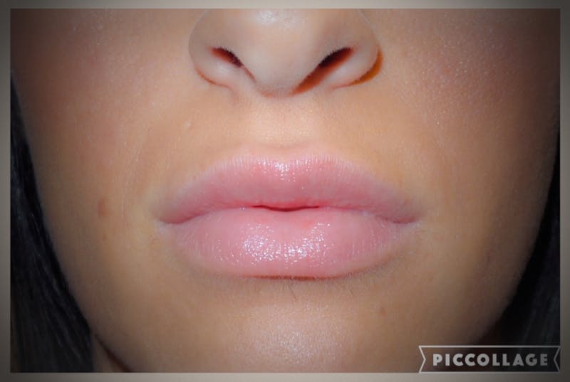 Lip Augmentation Before & After Gallery - Patient 270566 - Image 2
