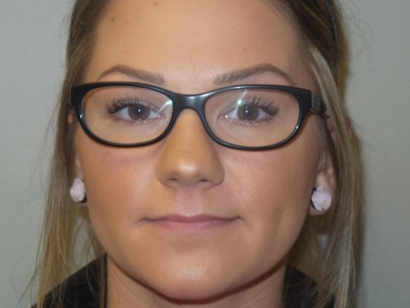 Lip Augmentation Before & After Gallery - Patient 279145 - Image 1