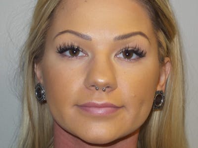 Lip Augmentation Before & After Gallery - Patient 279145 - Image 2