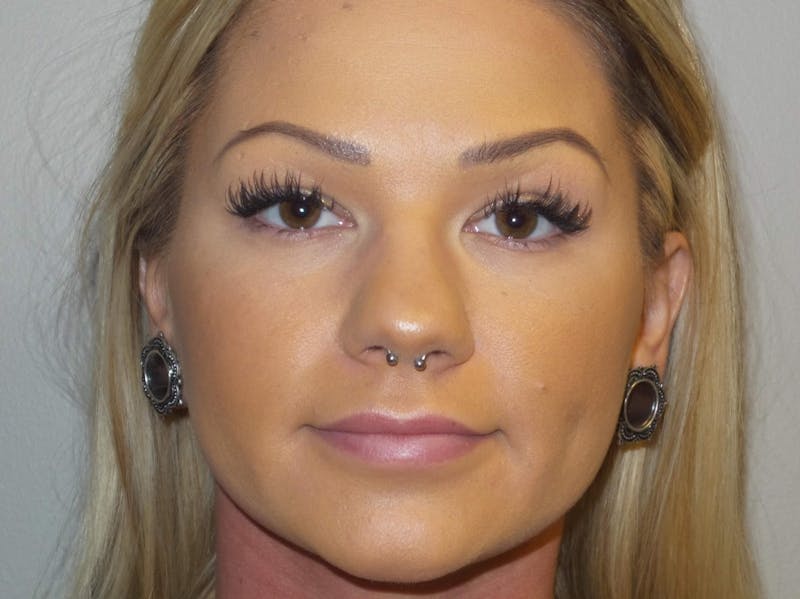 Lip Augmentation Before & After Gallery - Patient 279145 - Image 2