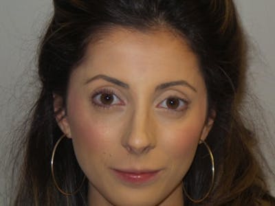 Lip Augmentation Before & After Gallery - Patient 200499 - Image 1