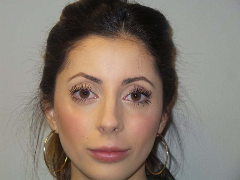 Lip Augmentation Before & After Gallery - Patient 200499 - Image 2