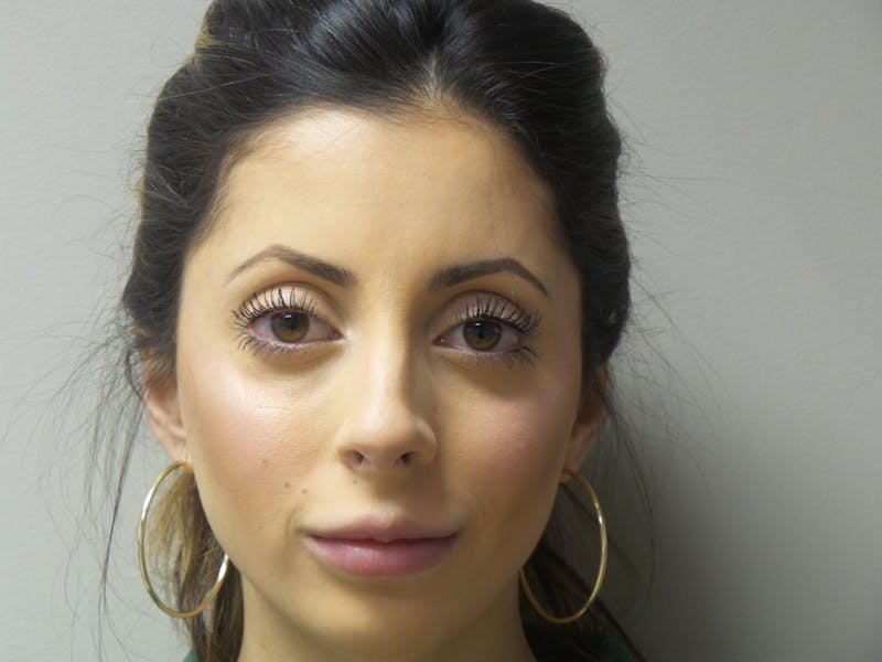 Lip Augmentation Before & After Gallery - Patient 200499 - Image 4