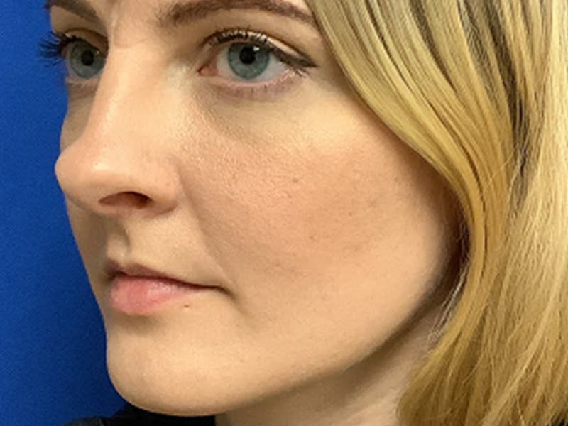 Lip Augmentation Before & After Gallery - Patient 771526 - Image 1