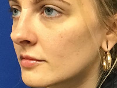 Lip Augmentation Before & After Gallery - Patient 771526 - Image 2