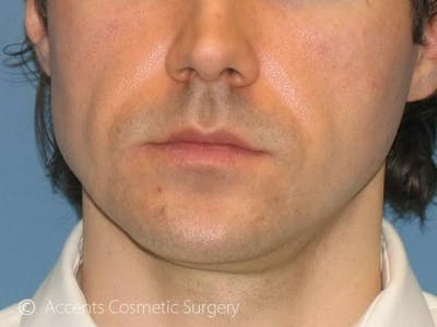 Naturalfill Before & After Gallery - Patient 744604 - Image 1