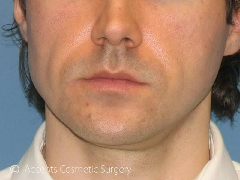 Naturalfill Before & After Gallery - Patient 744604 - Image 1