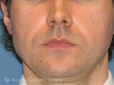 Naturalfill Before & After Gallery - Patient 744604 - Image 2