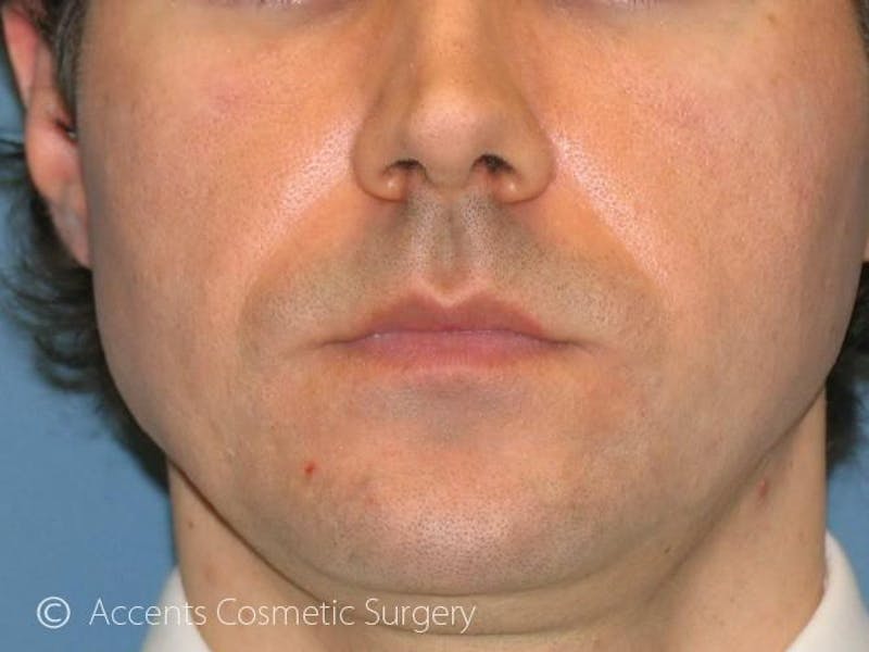 Naturalfill Before & After Gallery - Patient 744604 - Image 2