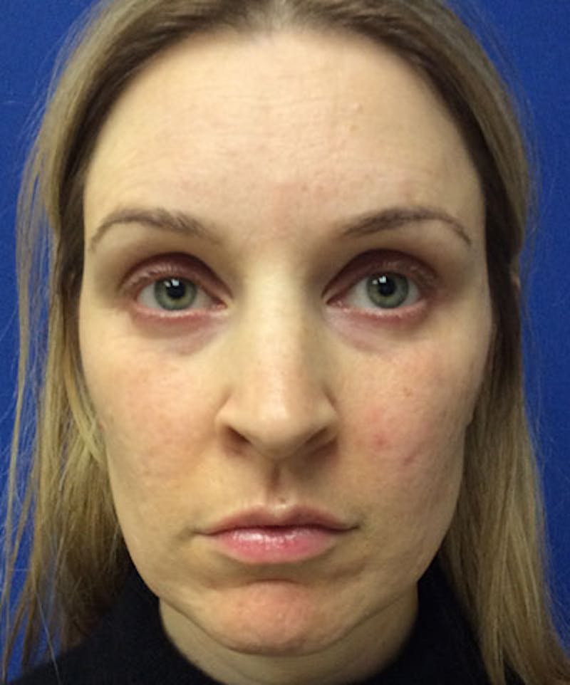 Voluma Before & After Gallery - Patient 305788 - Image 1