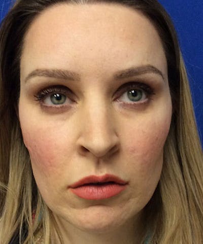 Voluma Before & After Gallery - Patient 305788 - Image 2