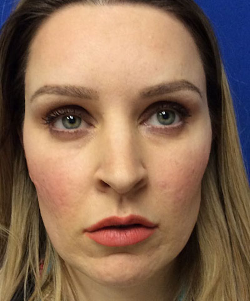 Voluma Before & After Gallery - Patient 305788 - Image 2