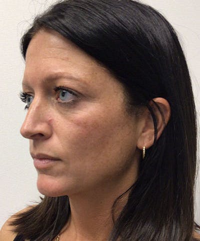 RHA Fillers Before & After Gallery - Patient 994414 - Image 1