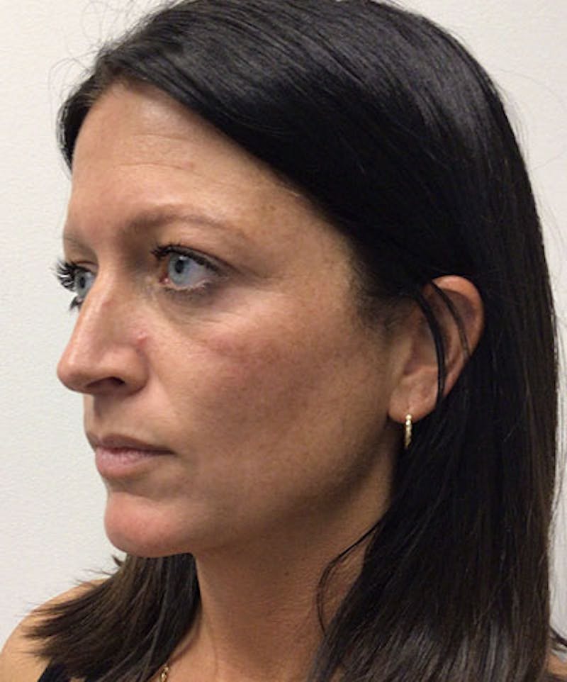 RHA Fillers Before & After Gallery - Patient 994414 - Image 1