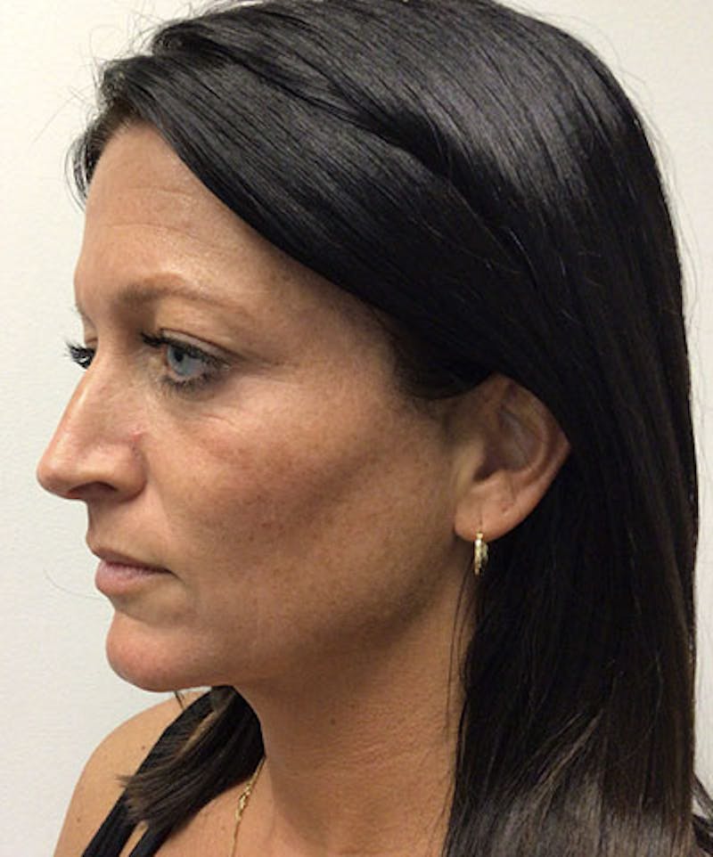 RHA Fillers Before & After Gallery - Patient 994414 - Image 2