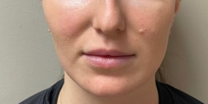 Jawline Contouring Before & After Gallery - Patient 236109 - Image 1