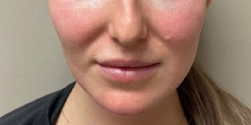 Jawline Contouring Before & After Gallery - Patient 236109 - Image 2