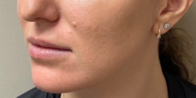 Jawline Contouring Before & After Gallery - Patient 236109 - Image 3