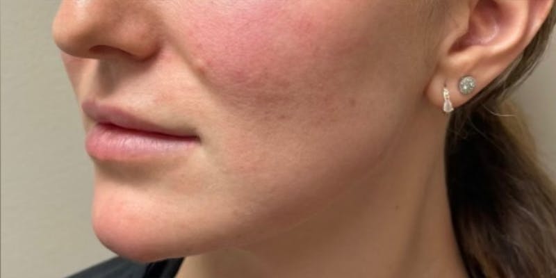 Jawline Contouring Before & After Gallery - Patient 236109 - Image 4