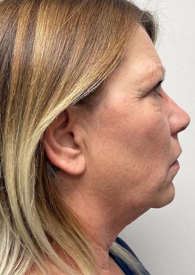 Jawline Contouring Before & After Gallery - Patient 114224 - Image 1